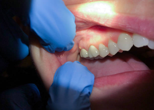 Best Emergency Tooth Extraction in Haubstadt, IN