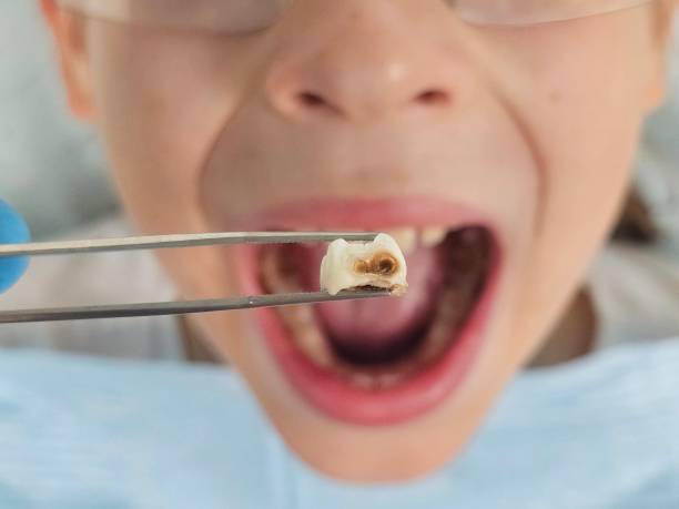 Best Emergency Root Canal Treatment in Haubstadt, IN